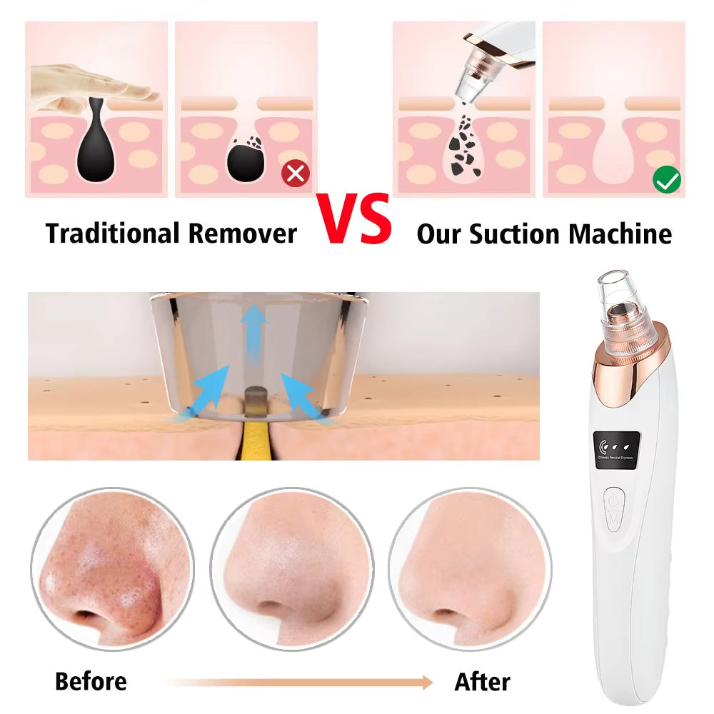 Facial Pore Vacuum