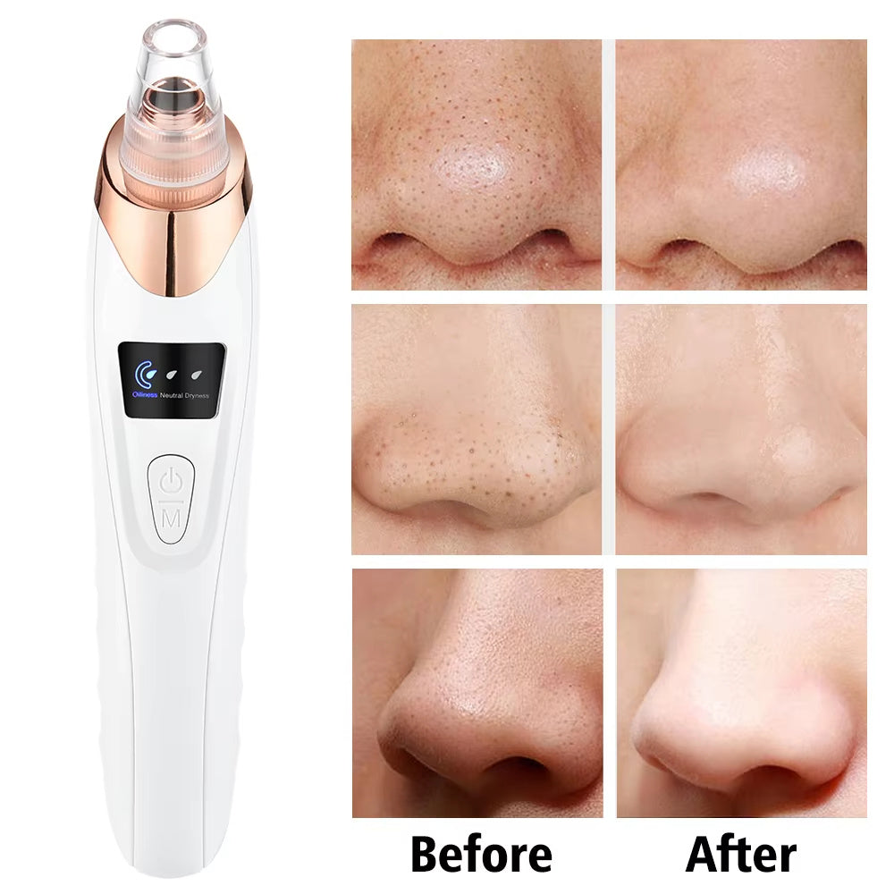 Facial Pore Vacuum